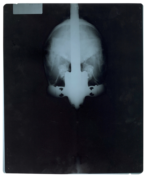 Group of X-Rays Showing Johnny Fox Swallowing a Sword.