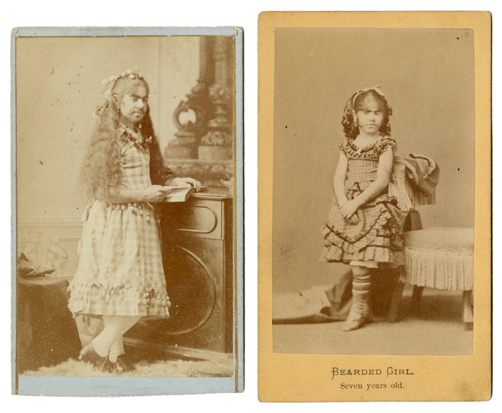  [BEARDED GIRLS]. Two CDV Portraits of Bearded Girls. 1880s....