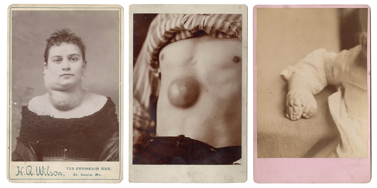  [MEDICAL ODDITIES]. Four Cabinet Cards Of Medical Oddities....