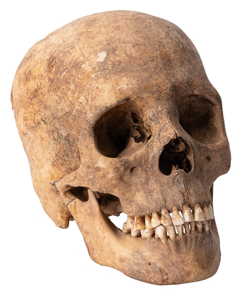  Human Skull. Human skull with occipital and rear parietal b...