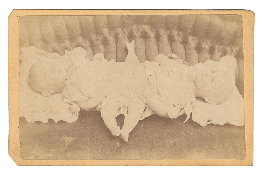 FINLEY, Mina and Minnie (1870–1871). CDV of conjoined twins...