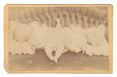 FINLEY, Mina and Minnie (1870–1871). CDV of conjoined twins...